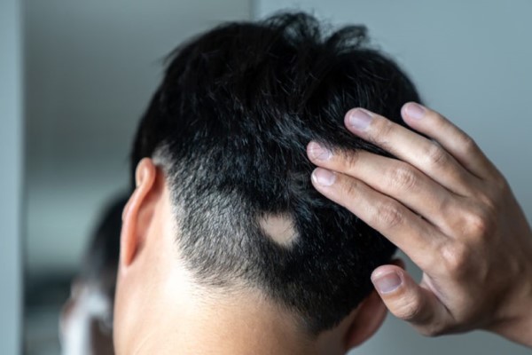 円形脱毛症とAGAとの違いについて解説!|あなたの薄毛はどんな症状?