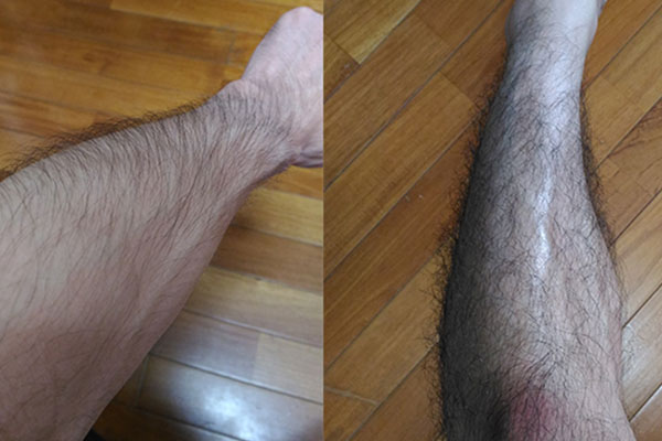 ミノキシジルタブレットで体毛は濃くなる?|実際に服用した人の体験談も紹介して解説します