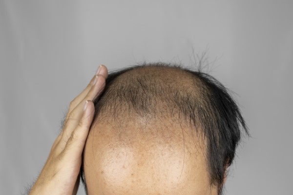 ミノキシジルタブレットは5mgと10㎎どっちを選ぶべき?|選び方も解説