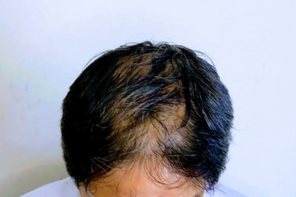 ミノキシジルタブレットをやめるとどうなる?|生えてた髪の毛は抜けるのか?