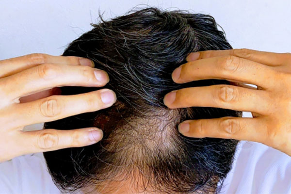 ミノキシジルの初期脱毛はいつまで続く?仕組みについて解説