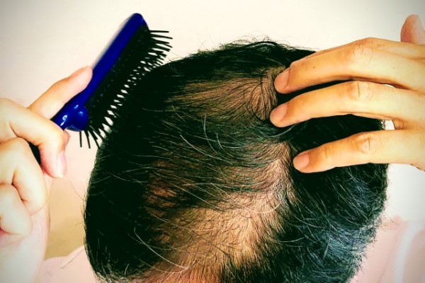 フィナステリドをやめたらどうなる?|AGAは再発するのか?