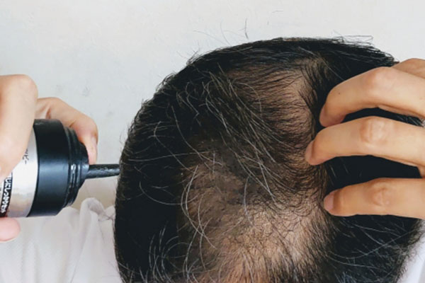 フィナステリドの塗り薬はあるのか?|内服薬との違いについて